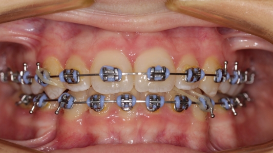 Отродонтическое лечение с помощью брекет-систем