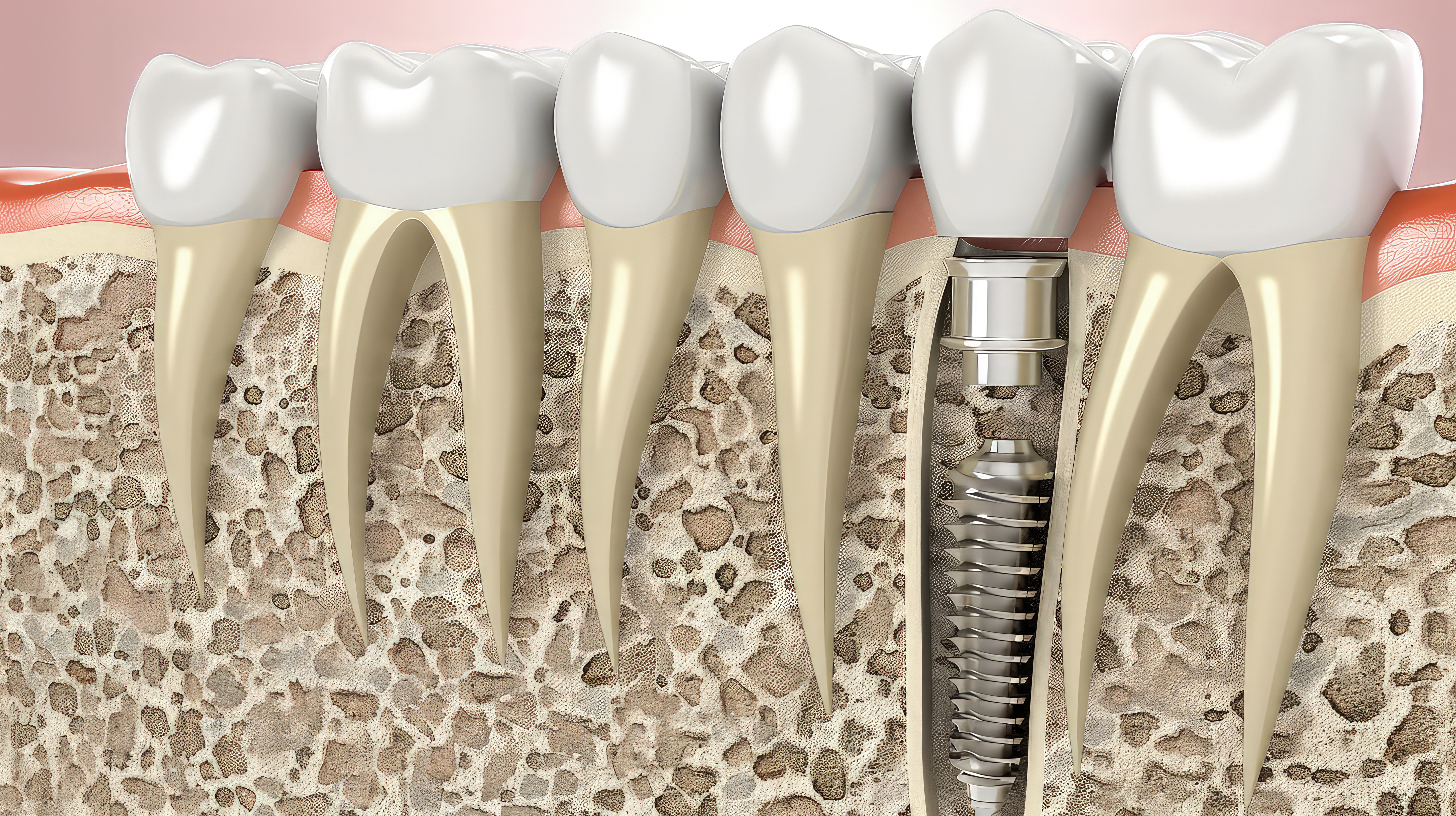 Имплантация зубов
