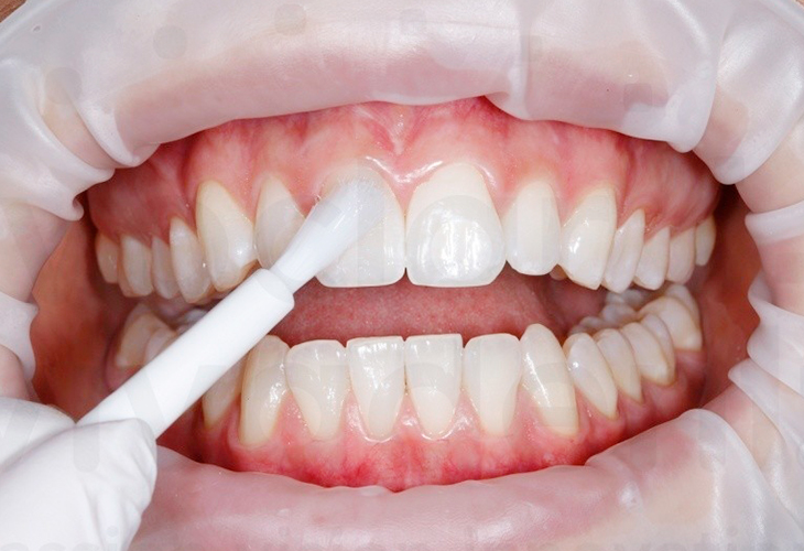 Реминерализация зубов 