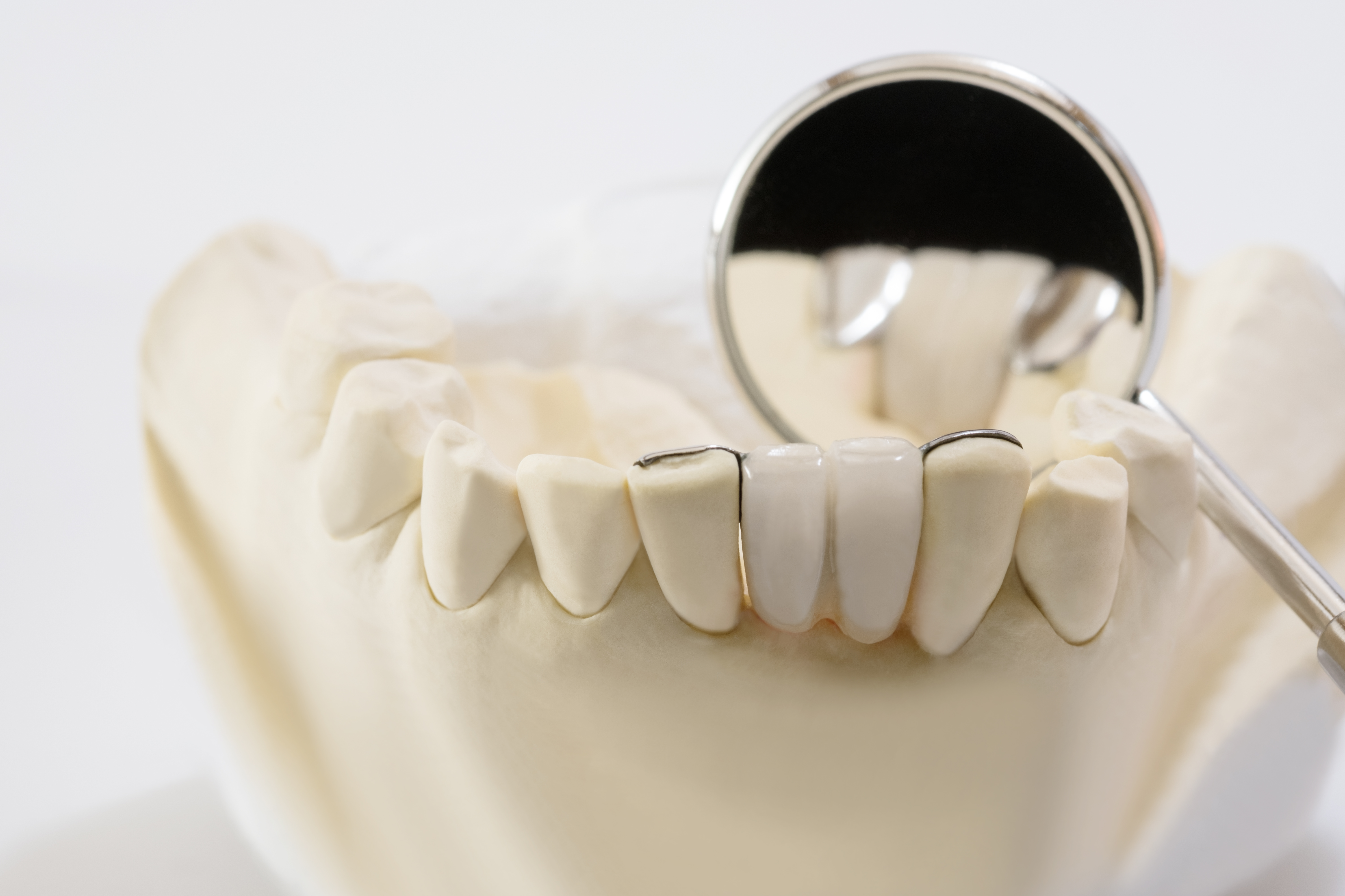 Бюгельное протезирование 