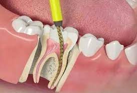Эндодонтия — лечение каналов зубов 